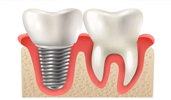 Dental Implants